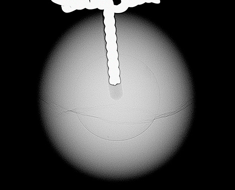 Figure 3. RTX image of a bead cultured pearl reference sample with a metal post in the drill hole. The metal appears radiopaque and matches the appearance of the core feature in the pearl examined in the present study. Figure 3. RTX image of a bead cultured pearl reference sample with a metal post in the drill hole. The metal appears radiopaque and matches the appearance of the core feature in the pearl examined in the present study.