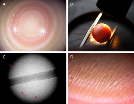 Figure 2. A: Concentric rings with alternating white, cream, and light pink color bands resembling a bull’s-eye; field of view 3 mm. B: Banded structure observed under fiber-optic illumination. C: Internal banding lines (red arrows) correlating to the external bands visible in image A. D: A pattern of parallel elongated slender flames imparting a silky sheen effect; field of view 1 mm. Photos by Gaurav Bera. Figure 2. A: Concentric rings with alternating white, cream, and light pink color bands resembling a bull’s-eye; field of view 3 mm. B: Banded structure observed under fiber-optic illumination. C: Internal banding lines (red arrows) correlating to the external bands visible in image A. D: A pattern of parallel elongated slender flames imparting a silky sheen effect; field of view 1 mm. Photos by Gaurav Bera.