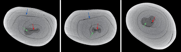 Three X-ray computed microtomography slices of a pearl Three X-ray computed microtomography slices of a pearl